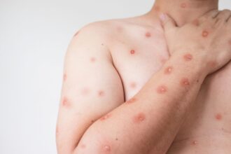 Chile se prepara frente a la amenaza de la viruela del mono, según Minsal