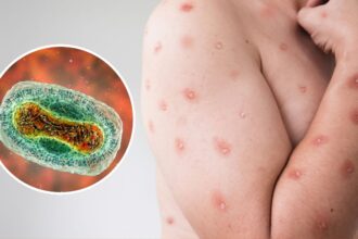 Alerta sanitaria por viruela del mono a nivel nacional y vacunación prioritaria para grupos vulnerables