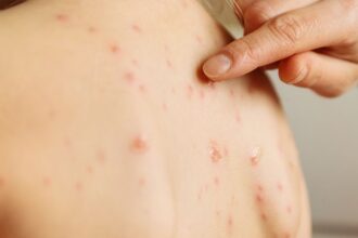 Brote de varicela en Escuela Casa Piedra de Tirúa: Estudiantes hospitalizados