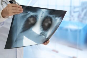 Alerta sanitaria: Minsal activa plan contra neumonía por mycoplasma