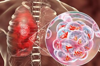 Tres fallecidos por brote de neumonía atípica en Chile