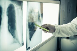 AI revoluciona detección de cáncer de pulmón con precisión del 94%