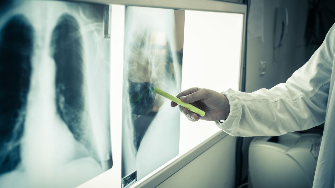 AI revoluciona detección de cáncer de pulmón con precisión del 94% AI revoluciona detección de cáncer de pulmón con precisión del 94%