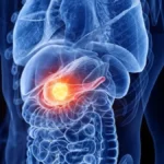 Conoce la verdad tras 9 mitos del cáncer de próstata que afectan a hombres