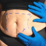 Costos y beneficios del Bono PAD para abdominoplastía en Chile