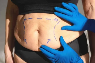 Costos y beneficios del Bono PAD para abdominoplastía en Chile