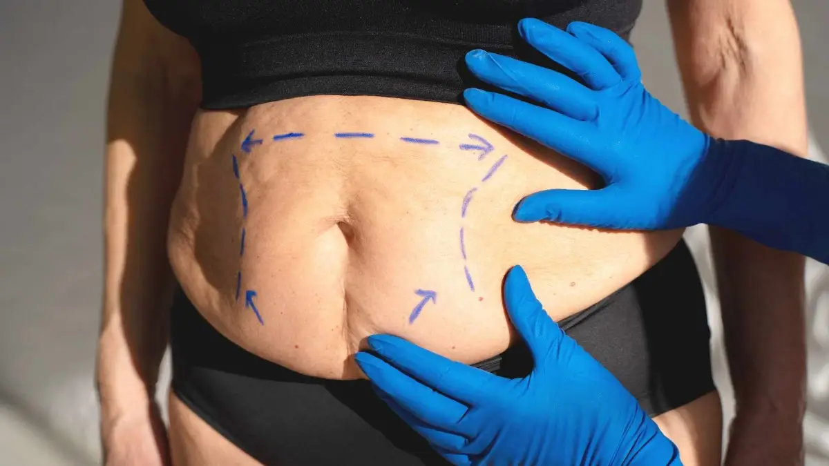 Costos y beneficios del Bono PAD para abdominoplastía en Chile Costos y beneficios del Bono PAD para abdominoplastía en Chile